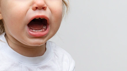 ¿Qué hacer si mi hijo tiene caries en  sus dientes de leche?