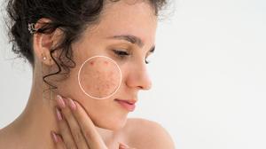 mh_por que sale acne durante el embarazo